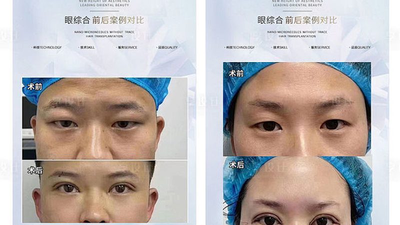 热玛吉面部眼部效果对比：揭秘技术差异与适用人群