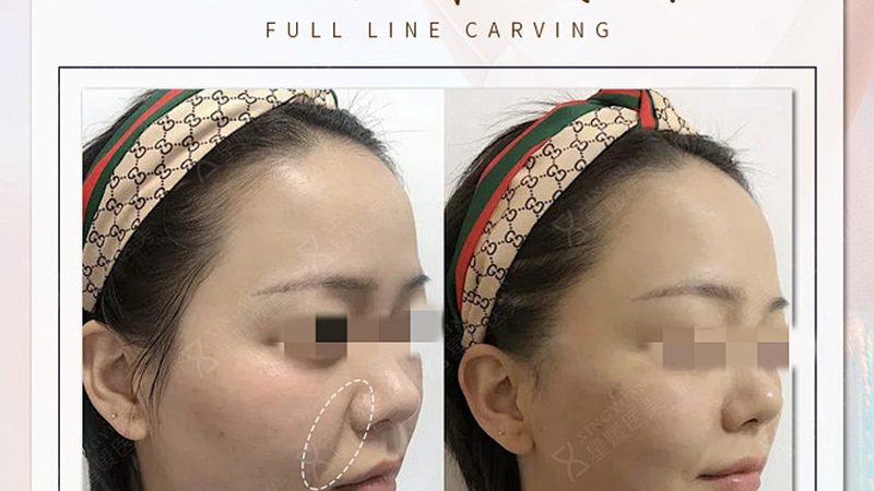 玻尿酸代理加盟，揭秘完整流程与关键步骤