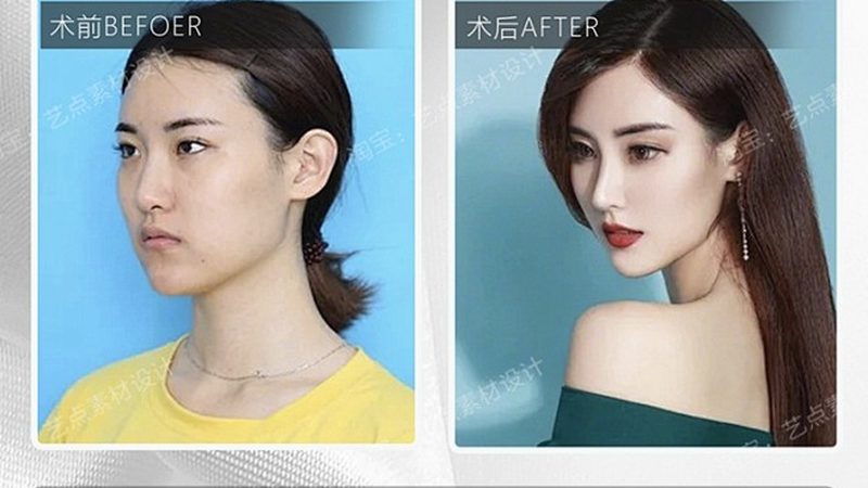 鼻子修复手术通常分为以下几个步骤：