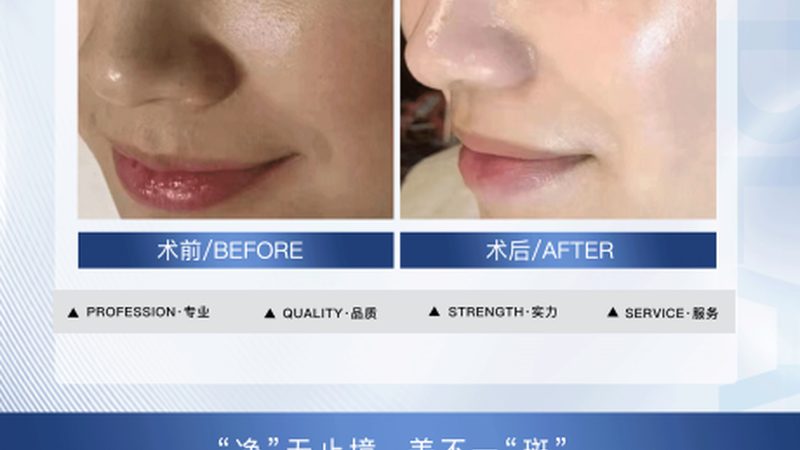 医用美容仪器参数对比，揭秘选购背后的秘密**