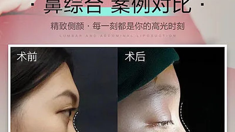 激光祛黄褐斑与光子嫩肤：效果对比解析