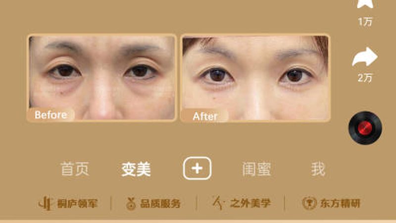 隆鼻手术风险解析：揭秘真实案例背后的风险与应对